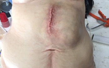 belly with stitches